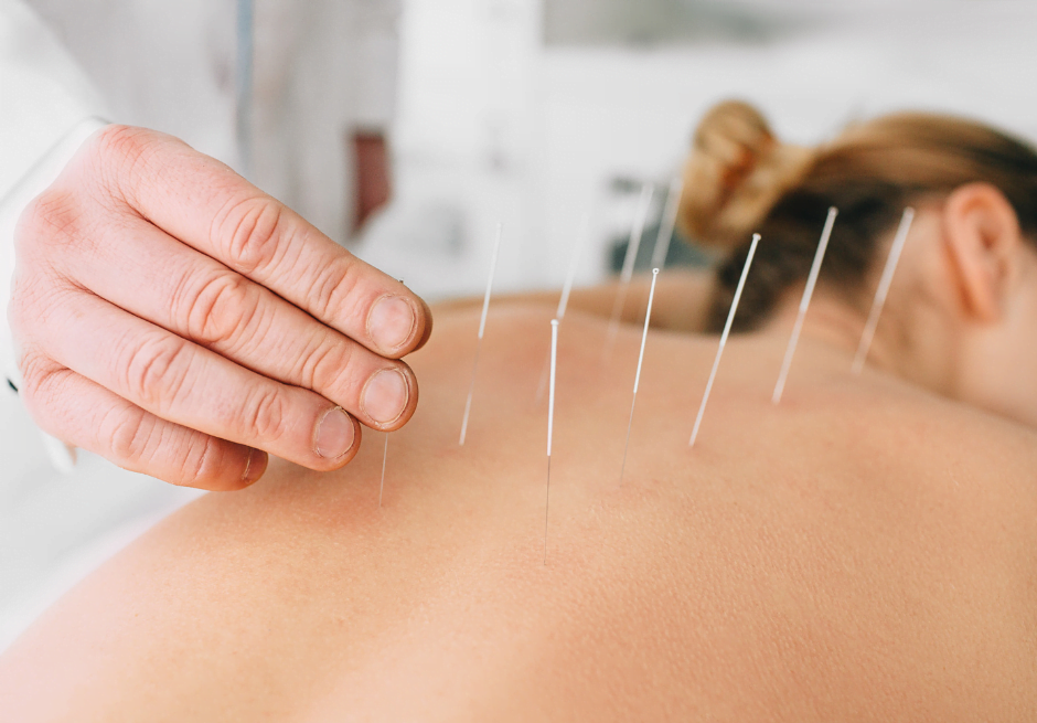 Acupuncture for musculoskeletal pain at our North Vancouver clinic