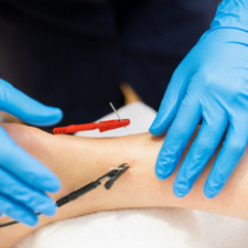 IMS dry needling performed by a registered physiotherapist in North Vancouver